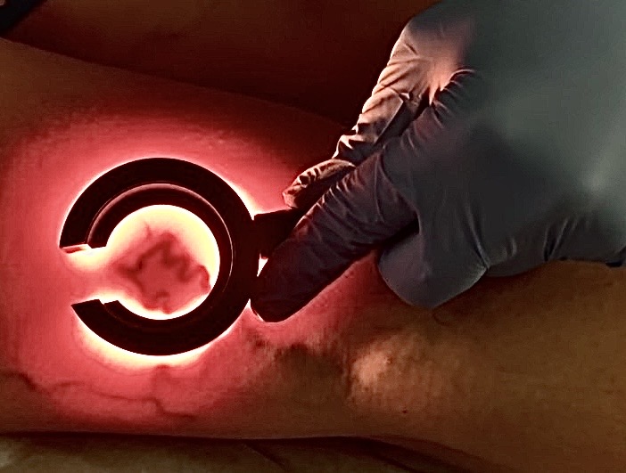 A image of a vein illuminated by red light