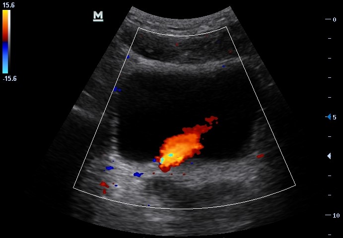 Sonogram of urinary bladder