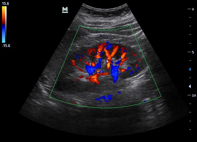 Sonogram of kidney