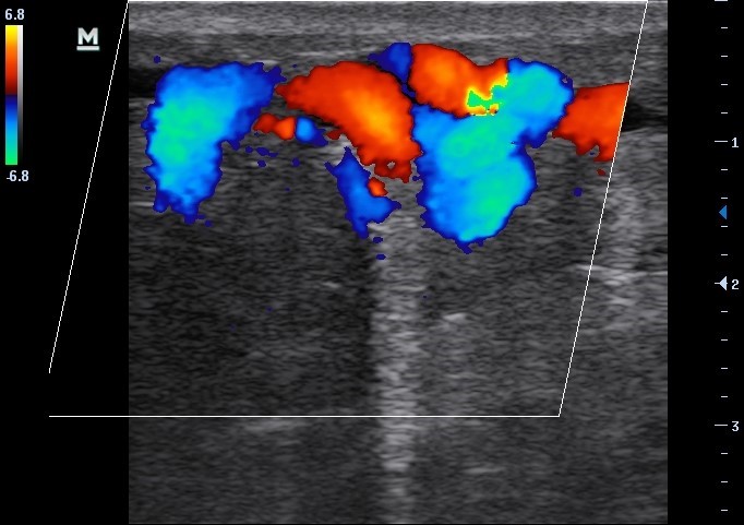 Sonogram of varicose veins
