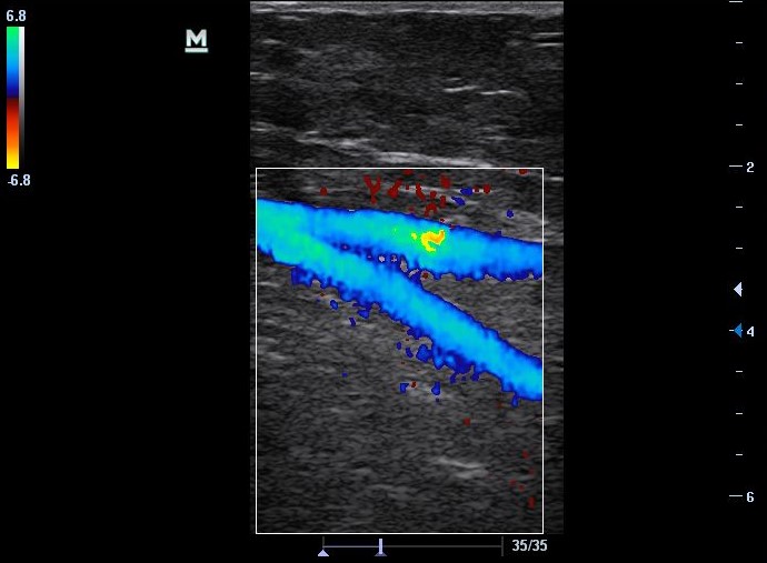 Sonogram of bifurcation of common femoral vein